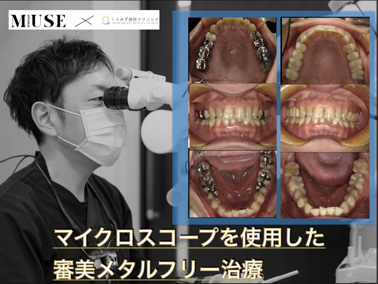 マイクロスコープを使用した審美メタルフリー治療