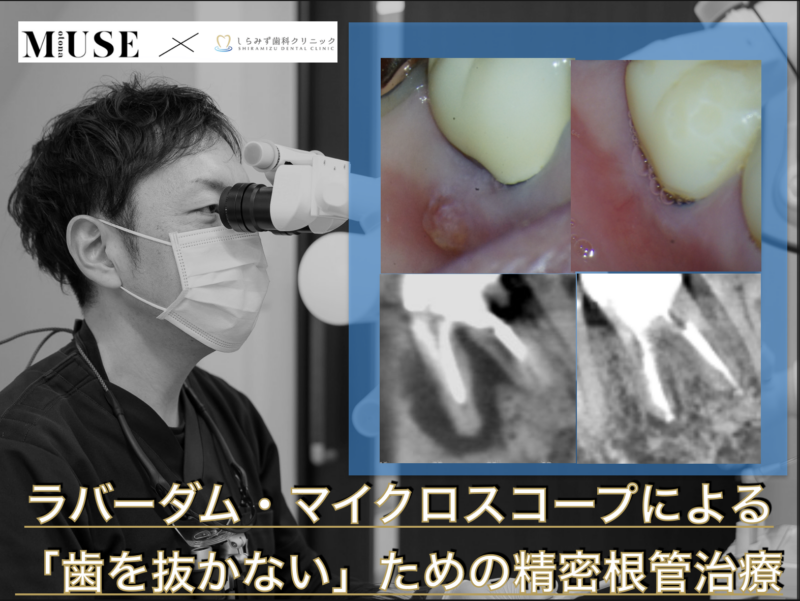 ラバーダム・マイクロスコープによる「歯を抜かない」ための精密根管治療